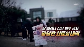 살 빼려다 집단 피부 괴사, 황당한 치료의 내막 | KBS방송 20200220