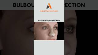 Bulbous Tip Correction | Answer Plastic Surgery #shorts #bulboustipcorrection