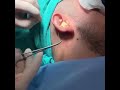 Otoplasty Surgery Under Local Anesthesia