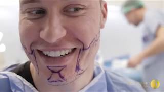 Hair and Beard Transplantation video, клиент Bellissimo Clinic