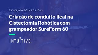 SureForm - Criação de Conduito Ileal na Cistectomia Robótica com grampeador SureForm 60