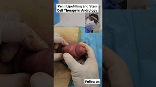 Penile Lipofilling and Stem cell therapy in Andrology Dr Araz Bayramov #penis penilenlargement.com