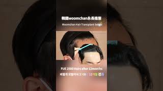 韓國永長專業植髮醫院，2500根頭髮植髮效果… #hairtransplantsurgery #韩国植发医院 #毛髮移植 #永長植髮 #永长植发 #fue #植发 #植髮 #fut #韓國免剃髮植髮