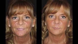 Liquid Facelift (+ voor- en nafoto's) | Furrow.nl