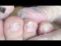 satisfying flat toenail treament