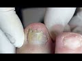 satisfying flat toenail treament