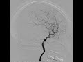 腦動脈瘤血管造影