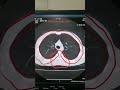 Chest Scan with few ground glass changes | Axial view in Lungs window | Dr Green Side | Medical Imag