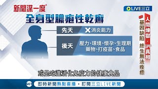 全台有500多位患者! 先天基因缺陷GPP發病如煉獄 終生無法痊癒.外觀缺陷 患者背負巨大心理壓力｜記者 曾奕慈 郭奕均 何世得 ｜【新聞深一度】20230517｜三立新聞台