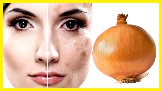 ONION MIRACLE, Which Removes Dark SUN SPOTS, Acne SCARS, Large PORES