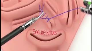 Ethicon proxisure suturing device ||viral in USA||