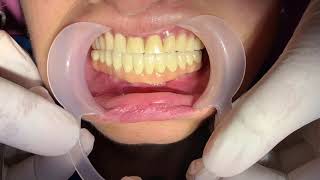 Dental Implant in Cambodia