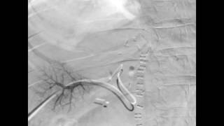 Portal Vein Embolization / Glubran2 :Editted by Tony Aoun