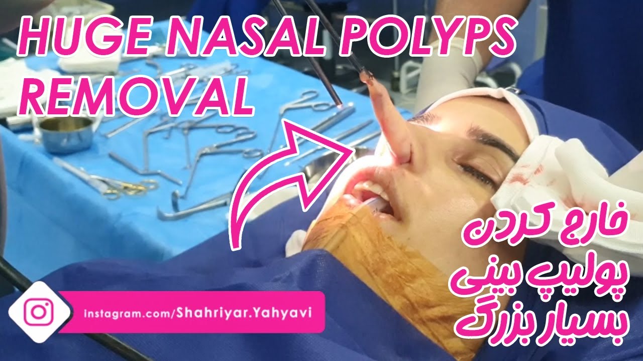 Endoscopic Nasal Polyp Removal