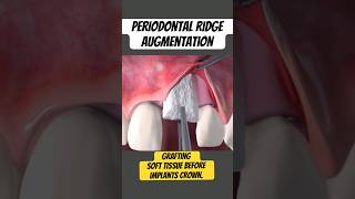 Ridge Augmentation, Soft tissue Grafting Dental Implants