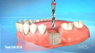 MIS SEVEN Implant Procedure Video