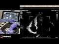 Piedmont Healthcare Stress Echo Protocol on the Philips Epic
