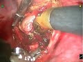 robotic mediastinal dissection of subcarinal space edited f. gharagozloo m.d.