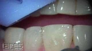 Veneer Removal, Tipless Handpiece - Lares PowerLase AT Laser