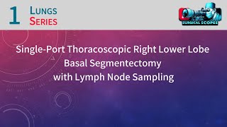 Single-Port Thoracoscopic Right Lower Lobe Basal Segmentectomy