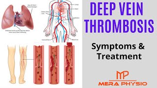 Deep Vein Thrombosis (DVT) | Causes, Symptoms, Treatment, Exercises | In Hindi | Mera Physio