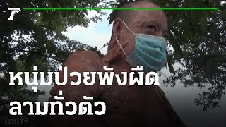 สุดเวทนา! หนุ่มออทิสติกป่วยพังผืดลามทั่วตัว | 27-05-64 | ไทยรัฐนิวส์โชว์