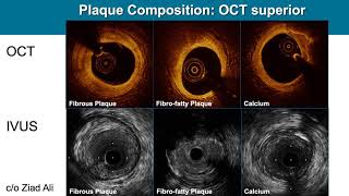 Precision PCI: The Link Between OCT Use and Lower Major Adverse Cardiac Events