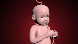 Nuchal cord- Umbilical cord becomes wrapped around the fetal neck 360 degrees.#education