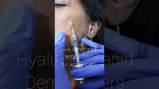Hyaluronic filler injections for acne scars.