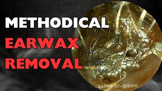 Methodical Earwax Removal