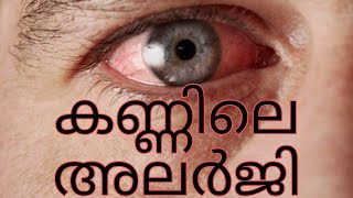 കണ്ണിലെ അലർജി, നിങ്ങൾ അറിഞ്ഞിരിക്കേണ്ടത് ||Introduction to eye allergy||eye health show