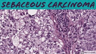 Sebaceous Carcinoma: 5-Minute Pathology Pearls