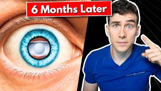 ICL Surgery 6-Month Update: The Good, The Bad, and the Unexpected