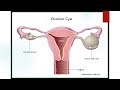 RCOG Guideline The Management of Ovarian Cysts in Postmenopausal Women No.34 RCOG Guideline The Management of Ovarian Cysts in Postmenopausal Women No.34
