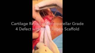 Cartilage Repair of Grade 4 Retropatellar Cartilage Defect with MaioRegen Implant