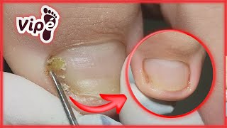 NAIL INFECTION SOLUTION  (OVERGROWN INFECTED INGROWN TOENAIL REMOVAL)