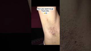 Underarm ingrown hair bumps #ingrown hair #underarmcare #skincare #skincareshorts #skincaretips