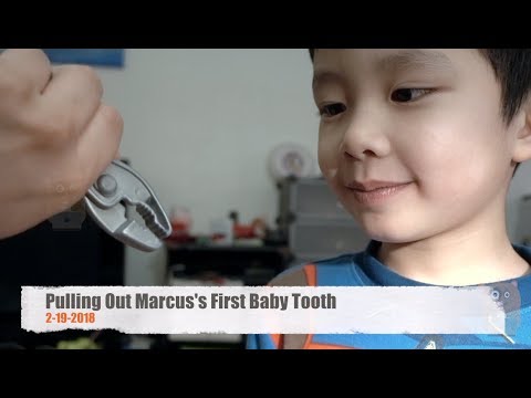 Pulling Out Marcus's First Baby Tooth Pulling Out Marcus's First Baby Tooth