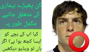 Mumps | | kan pheray | | Explained by Dr Ahsan