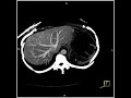 abdomen liver focal nodular hyperplasia hypervascular lesion of the feeding vessel 5 of 5