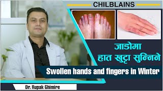 Chilblains : किन जाडोमा हात खुट्टा सुन्निने  हुन्छ ? | Swollen hands and fingers in Winter