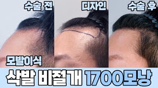 남성🧑모발이식 전후영상🎬삭발비절개 1700모낭｜모발이식｜헤어라인교정｜두피문신｜다나성형외과DANA