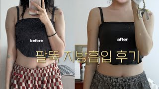 팔뚝 + 부유방 지방 흡입 1달차 후기 그리고 QnA (^з^)-☆