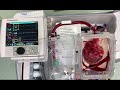 Scotland's first 'non-beating' heart transplant