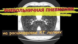 ВНЕБОЛЬНИЧНАЯ полисегментарная ПНЕВМОНИЯ на расшифровке КТ легких.  Внебольничная пневмония симптомы