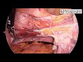 skin to skin total laparoscopic hysterectomy explained for bulky uterus