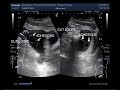 Ultrasound Video showing multiple adhesions in free fluid in abdominal cavity .