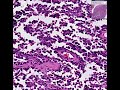 histopathology skeletal muscle face alveolar rhabdomyosarc