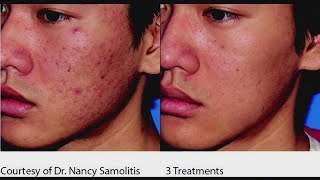 Benefits of microneedling