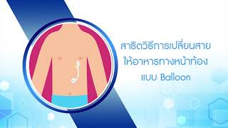 สาธิตวิธีการเปลี่ยนสายให้อาหารทางหน้าท้อง แบบ Balloon